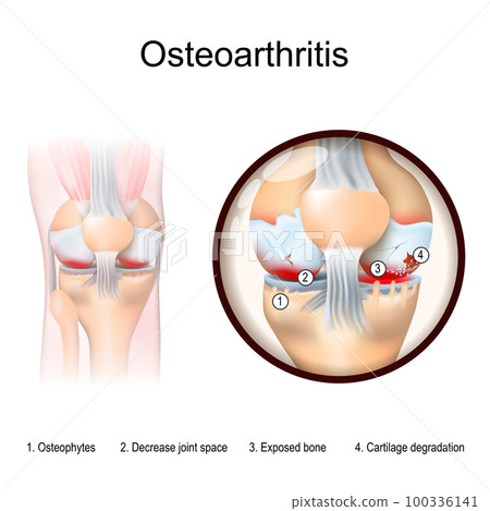 Close-up of knee joint with  arthritis symptoms 100336141