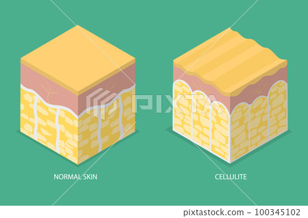3D Isometric Flat Vector Conceptual Illustration of Cellulite Skin 3D Isometric Flat Vector Conceptual Illustration of Cellulite Skin 100345102
