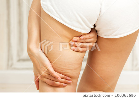 大腿脂肪/年輕女子 大腿脂肪/年輕女子 100363690