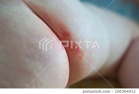 Red diaper rash on the pope of a baby from a diaper. Irritation on the delicate skin of an infant. Dermatitis Red diaper rash on the pope of a baby from a diaper. Irritation on the delicate skin of an infant. Dermatitis 100364912