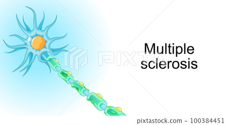 Multiple sclerosis. demyelinating disease. autoimmune disease. Vector 100384451