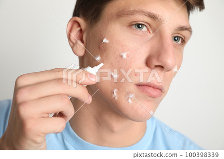 Teen guy with acne problem applying cream on light background, closeup 100398339