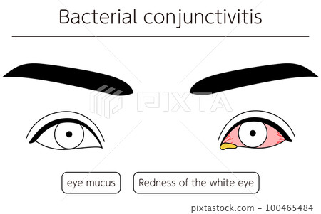Medical illustration, line drawing illustration of eye disease, bacterial conjunctivitis 100465484