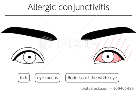 Medical illustration, line drawing illustration of eye disease/allergic conjunctivitis 100465486