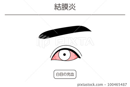 Medical illustration, line drawing illustration of eye disease and conjunctivitis 100465487