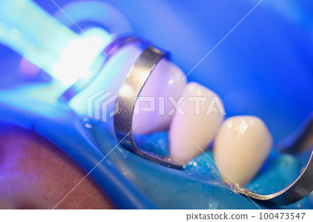 Light falling on teeth during installation of veneers in dental clinic closeup Light falling on teeth during installation of veneers in dental clinic closeup 100473547