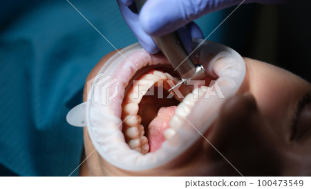 Dentist treating patient teeth with drill in dental clinic closeup Dentist treating patient teeth with drill in dental clinic closeup 100473549