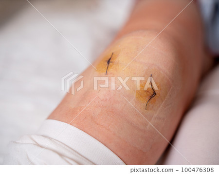 Close-up of a woman's knee joint with stitches after arthroscopy surgery Close-up of a woman's knee joint with stitches after arthroscopy surgery 100476308