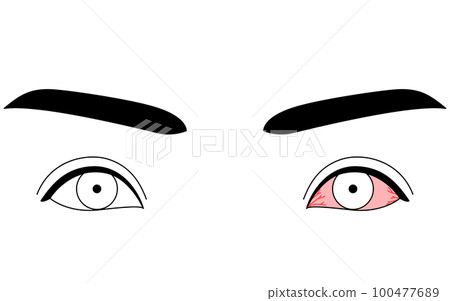 眼病和結膜炎的醫學插圖、線描插圖 100477689