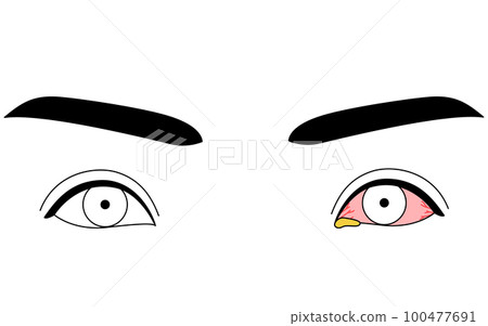 Medical illustration, line drawing illustration of eye disease, bacterial conjunctivitis Medical illustration, line drawing illustration of eye disease, bacterial conjunctivitis 100477691
