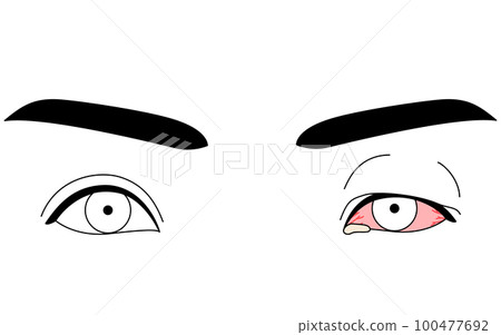 Medical illustration, line drawing illustration of eye disease, viral conjunctivitis Medical illustration, line drawing illustration of eye disease, viral conjunctivitis 100477692