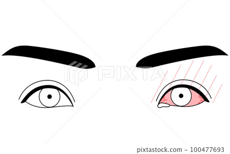 醫學插圖,眼病/過敏性結膜炎的線描插圖 醫學插圖,眼病/過敏性結膜炎的線描插圖 100477693