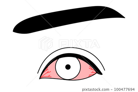 Medical illustration, line drawing illustration of eye disease and conjunctivitis Medical illustration, line drawing illustration of eye disease and conjunctivitis 100477694