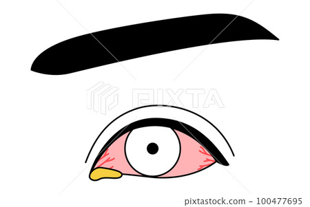Medical illustration, line drawing illustration of eye disease, bacterial conjunctivitis Medical illustration, line drawing illustration of eye disease, bacterial conjunctivitis 100477695