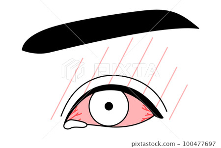 Medical illustration, line drawing illustration of eye disease/allergic conjunctivitis 100477697