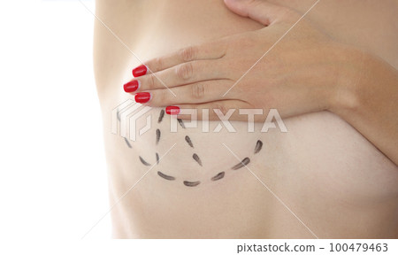 Correction lift breast augmentation and plastic surgery 100479463