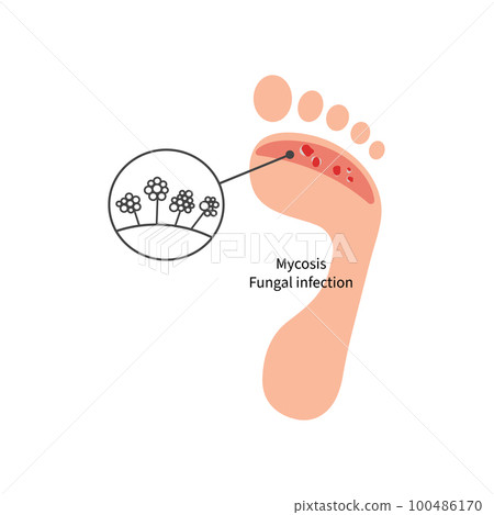 Foot with fungal skin disease 100486170