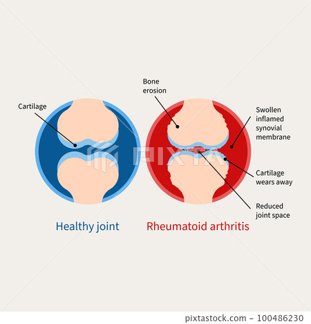 Rheumatoid arthritis illustration 100486230