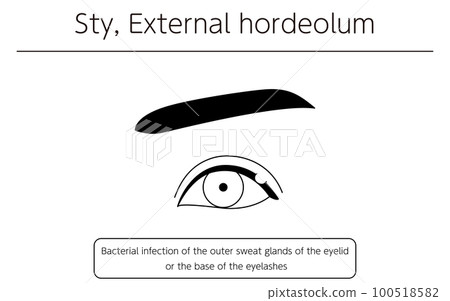 Medical illustration, line drawing illustration of eye disease / stye (outer hordeolum) 100518582
