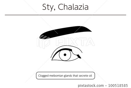 Medical illustration, line drawing illustration of eye disease / stye (chalazion) 100518585