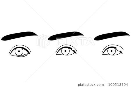 醫學插圖，眼部疾病/麥粒腫（內麥粒腫，外麥粒腫，霰粒腫）的線描插圖 100518594