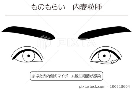 Medical illustration, line drawing illustration of eye disease / stye (inner stye) Medical illustration, line drawing illustration of eye disease / stye (inner stye) 100518604