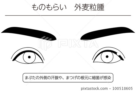Medical illustration, line drawing illustration of eye disease / stye (outer hordeolum) 100518605
