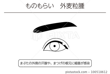 Medical illustration, line drawing illustration of eye disease / stye (outer hordeolum) 100518612