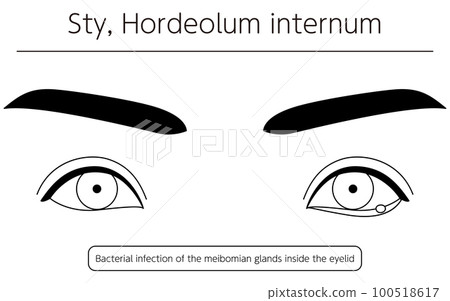 Medical illustration, line drawing illustration of eye disease / stye (inner stye) 100518617