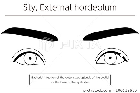 醫學插圖，眼病/麥粒腫（外麥粒腫）的線描插圖 100518619