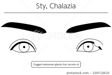 Medical illustration, line drawing illustration of eye disease / stye (chalazion) Medical illustration, line drawing illustration of eye disease / stye (chalazion) 100518620