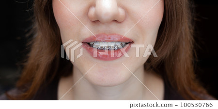The smile of a young and beautiful girl with braces on her white teeth. Straightening of crooked teeth with the help of a bracket system. Malocclusion. Dental care. Smooth teeth and a beautiful smile The smile of a young and beautiful girl with braces on her white teeth. Straightening of crooked teeth with the help of a bracket system. Malocclusion. Dental care. Smooth teeth and a beautiful smile 100530766