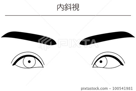 醫學插圖、眼病、斜視 100541981