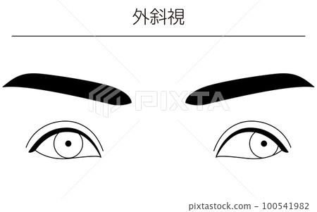 醫學插圖、眼病、斜視 100541982