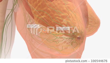 Stage III breast tumors are invasive and have spread to the lymph nodes around the collar bone or those deep within the breast. Stage III breast tumors are invasive and have spread to the lymph nodes around the collar bone or those deep within the breast. 100544676