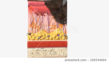 The In Stage III ALM Acral Lentiginous Melanoma The In Stage III ALM Acral Lentiginous Melanoma 100544684