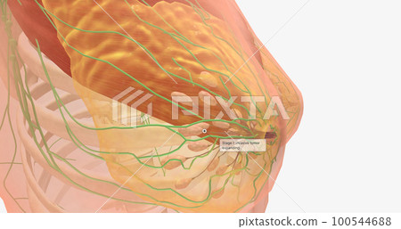 Stage I breast tumors are invasive and have started to spread to the fatty breast tissue or to nearby lymph nodes. 100544688