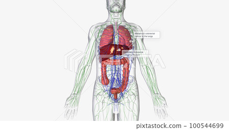 Colorectal cancer (CRC) is a common colon or rectal cancer that affects many patients over middle age. 100544699
