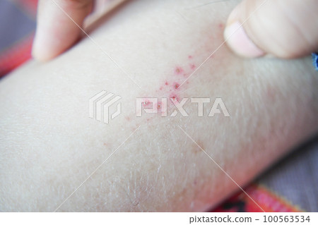 man suffering from itching skin, close up. 100563534