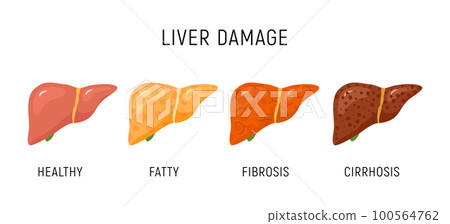 Liver damage infographic diagram cancer disease anatomy. Liver damage organ tissue hepatic carcinoma Liver damage infographic diagram cancer disease anatomy. Liver damage organ tissue hepatic carcinoma 100564762