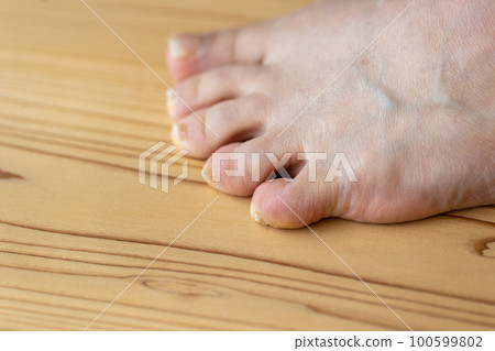 中年女人的腳,小指是睡指 中年女人的腳,小指是睡指 100599802