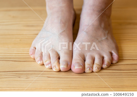 中年女人的腳,小指是睡指 中年女人的腳,小指是睡指 100649150