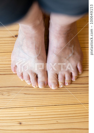 Feet of a middle-aged woman whose little finger is a sleeping finger 100649153