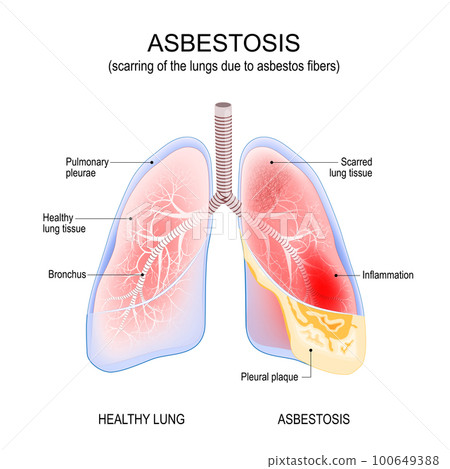 asbestosis lungs. Inflammation and scarring of the lungs 100649388