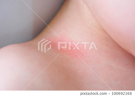 little asian girl skin rash and allergy with red spot cause by mosquito bite at neck 100692168