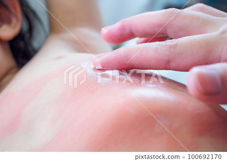 Doctor hand applying topical antihistamine medicine cream on little girl body with severe skin rash and allergy Doctor hand applying topical antihistamine medicine cream on little girl body with severe skin rash and allergy 100692170