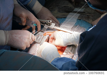 Closeup of professional doctor hands operating a patient during open heart surgery in surgical room. Healthcare and medical intervention concept Closeup of professional doctor hands operating a patient during open heart surgery in surgical room. Healthcare and medical intervention concept 100760691