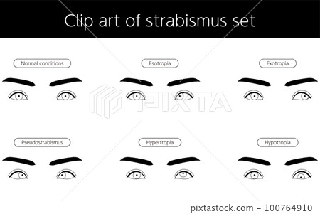 Medical illustration, eye disease, strabismus Illustrated line drawing illustration of exotropia 100764910