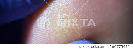 Inflamed dry callus with peeling of skin and doctor hands 100775651