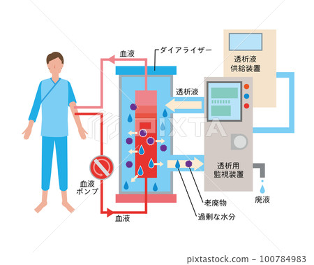 人工透析治療的形像說明 人工透析治療的形像說明 100784983
